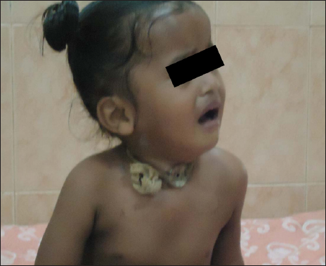 Child with metallic tracheostomy tube.